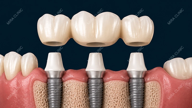 Cement-Retained Implant Bridge